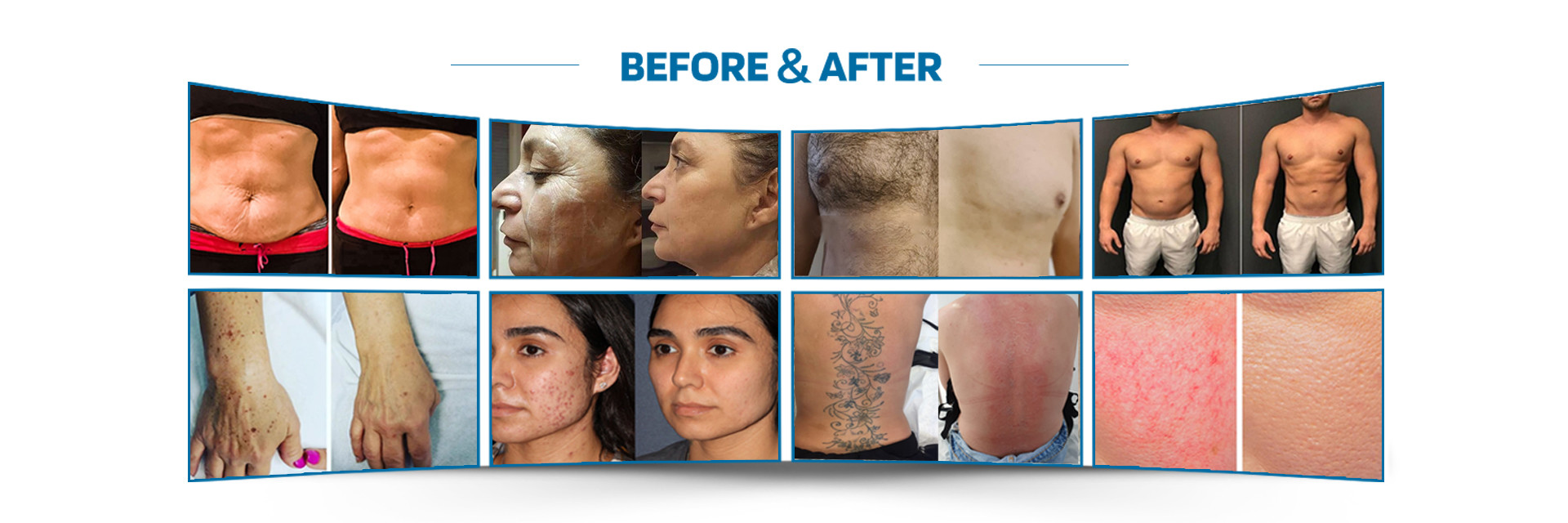 kwaliteit De Verwijderingsmachine van het laserhaar fabriek